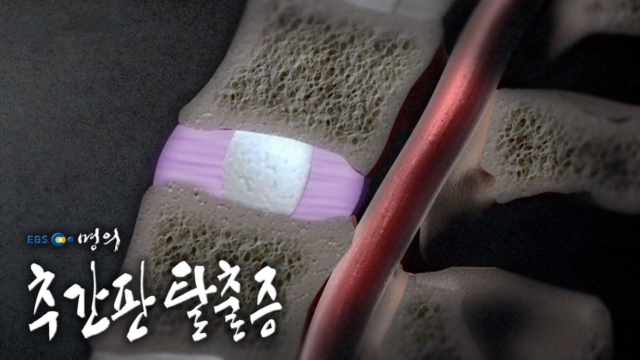 [명의 의학백과📖] 추간판탈출증 - YouTube