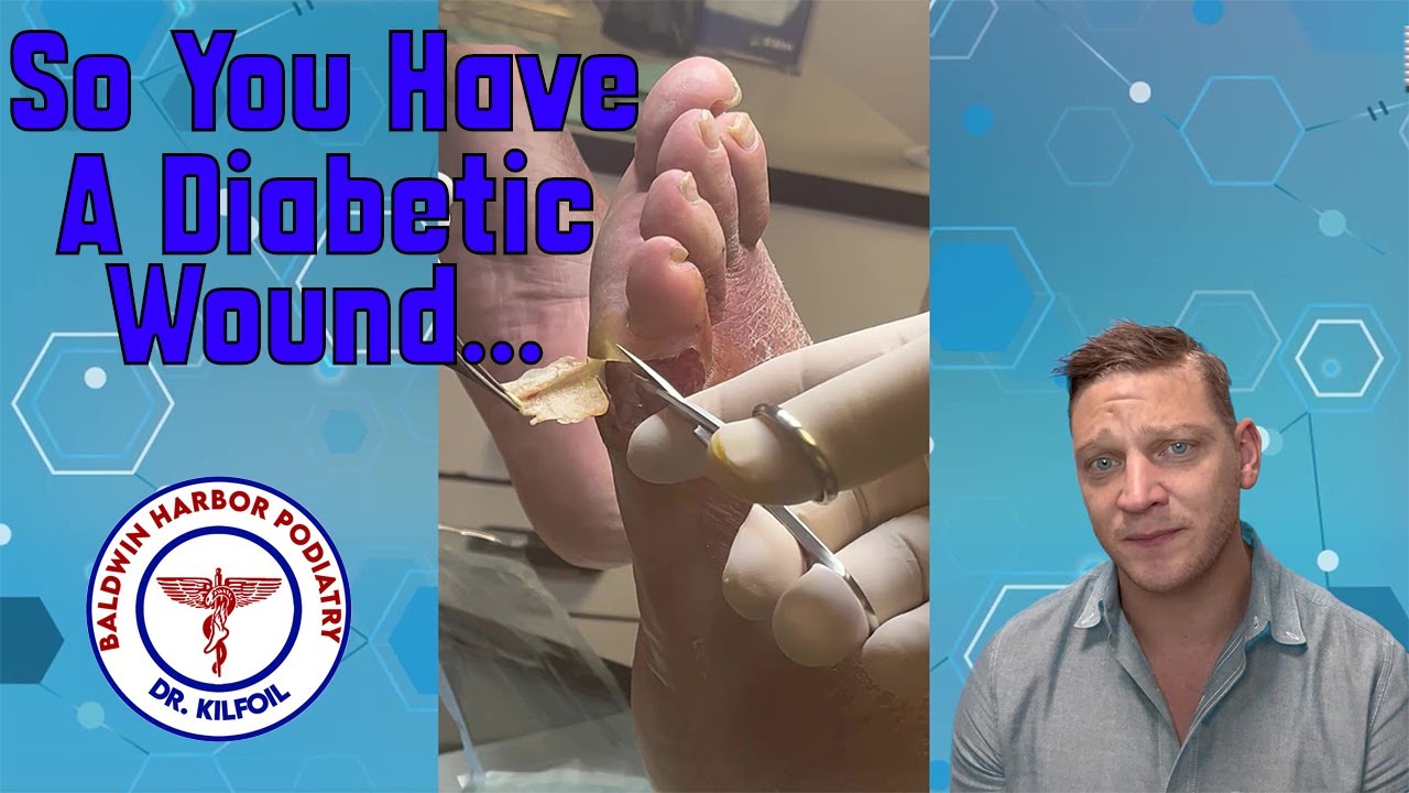 So You Have A Diabetic Wound Deroofing And Debridement With NECROSIS So You Have A Diabetic Wound Deroofing And Debridement With NECROSIS
