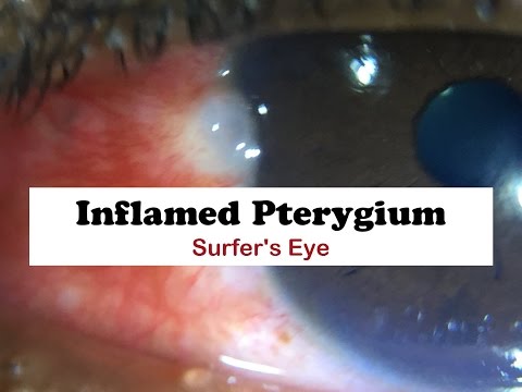 Inflamed Pterygium