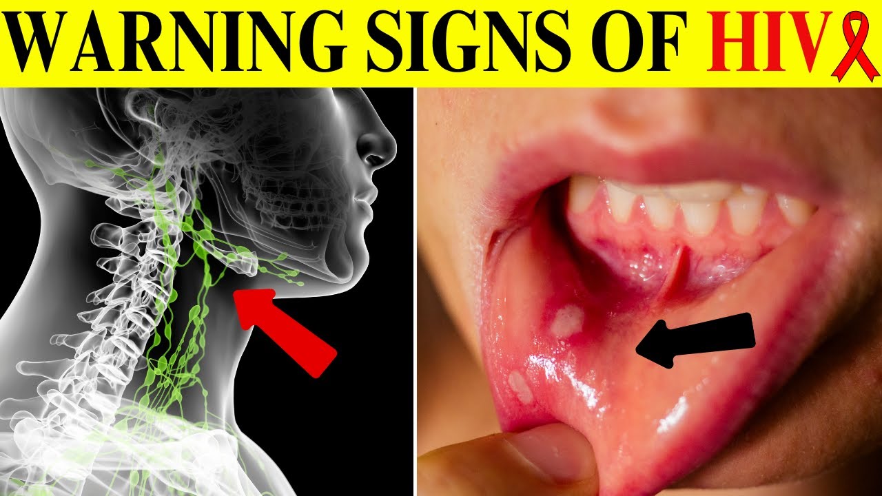 Identify The Early Signs of HIV/AIDS | Sign of HIV Positive - YouTube