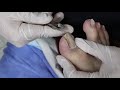 EP_1209 Ingrown toenail removal 👣 ไม่ต้องกลัว..ไม่เจ็บ 😷 (This clip from Thailand)