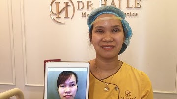 Cắt Mí Không Sưng Tím Bằng Công Nghệ Mani Open Deep 5D.