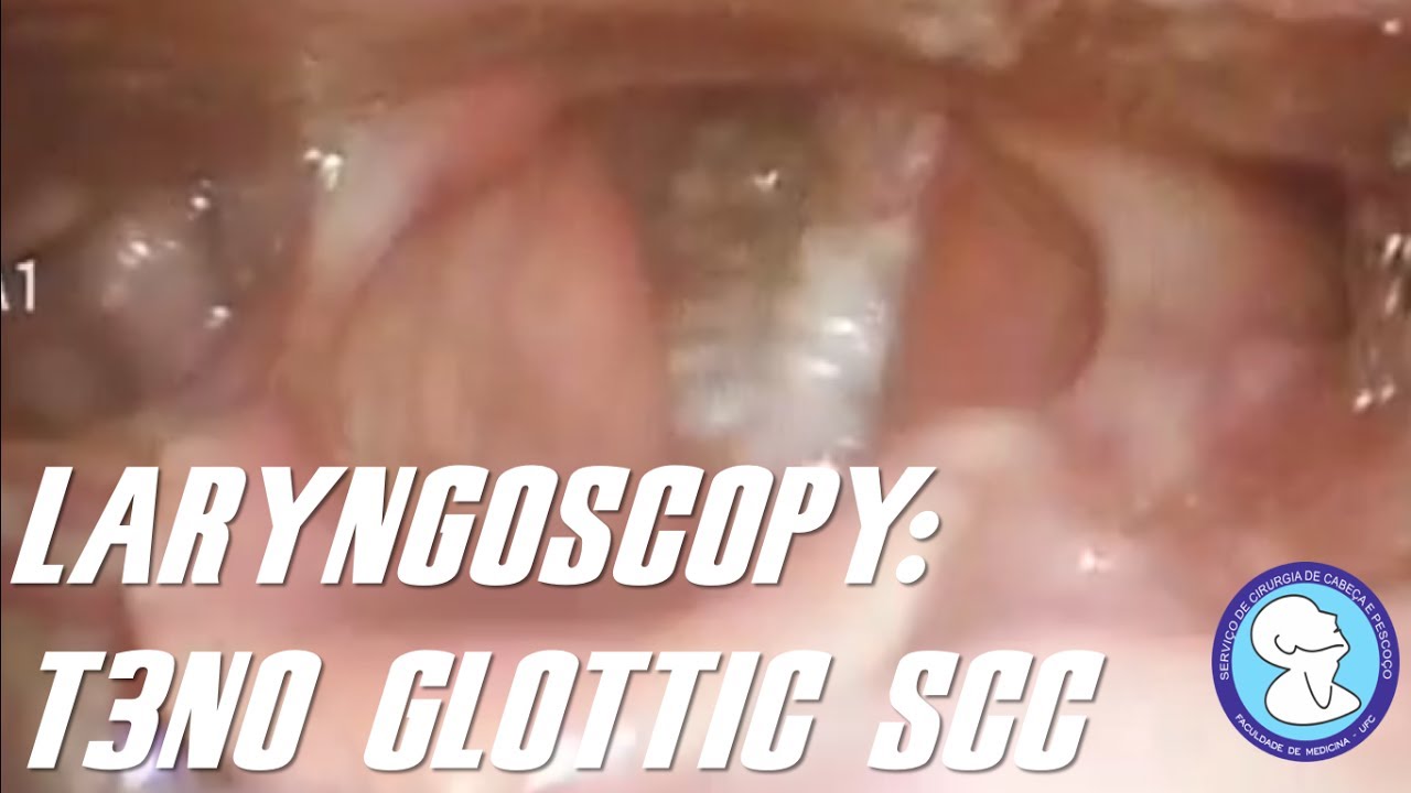 LARYNGOSCOPY T3N0 GLOTTIC SQUAMOUS CELL CARCINOMA YouTube