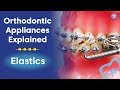 Orthodontic appliances explained  elastics