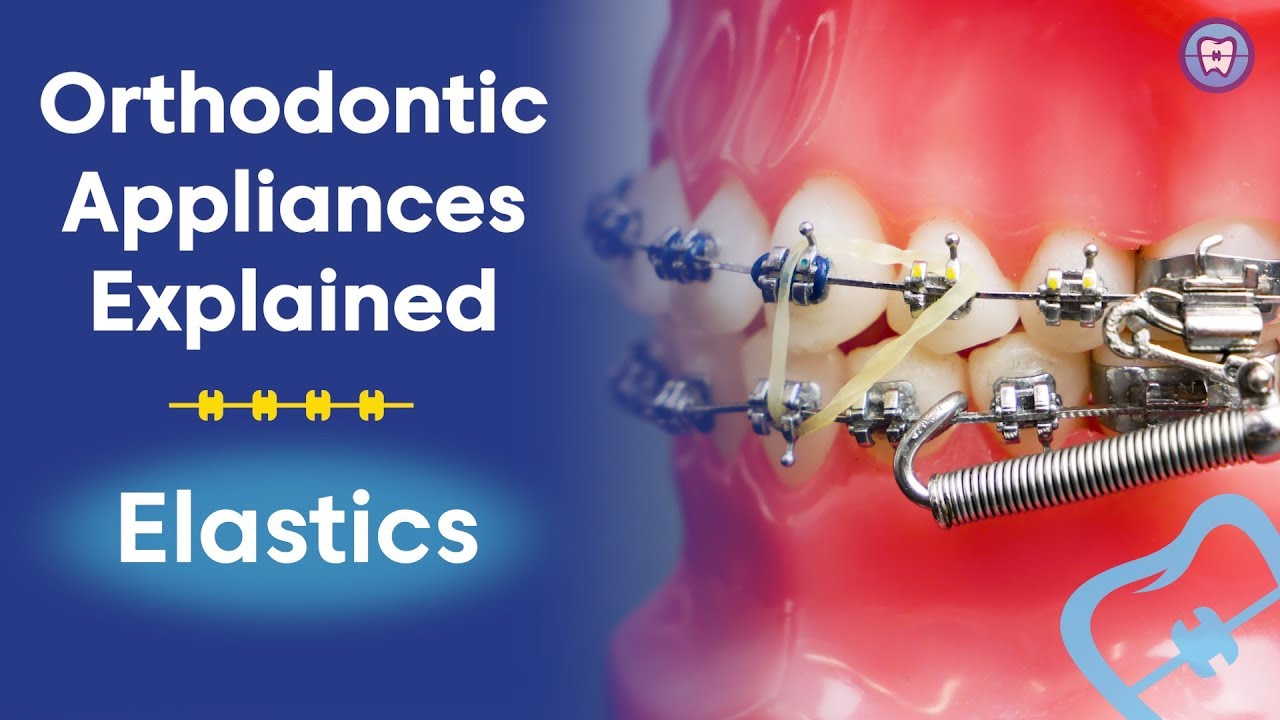 How to use Elastics - Orthodontic Appliances - Doctor Emma