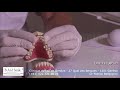 Orthodontie des classes ii avec invisalign  les dents en avant