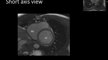 TMT: Cardiac MR by Dr Avanti Gulhane: Anatomy Basics