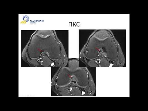 Базовый курс по МРТ «МР анатомия коленного сустава и методика сбора данных 2»  Лектор  Катков А М