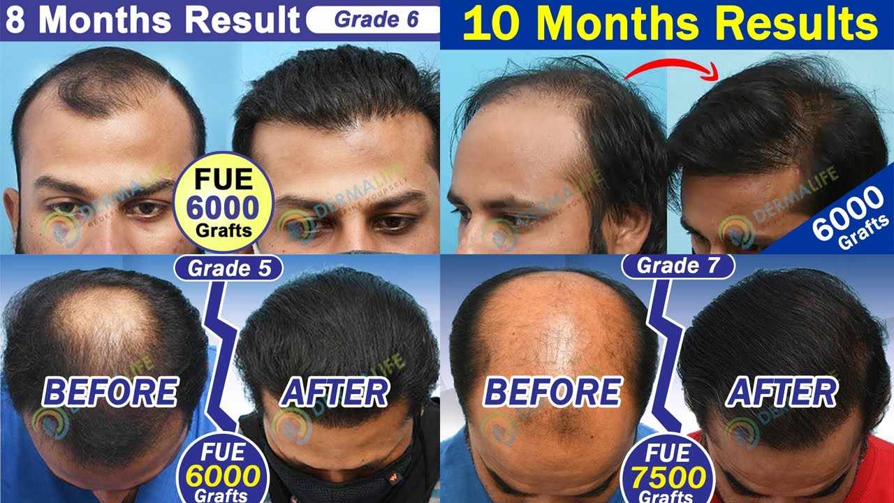 😲Mesmerizing Hair Transplant Results | Before and After | Best Hair  Transplant in India | Dermalife - YouTube