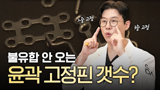 윤곽 수술 부작용 NO.1 불유합⚠️ 핵심은 고정핀! (광대 재수술 사례)