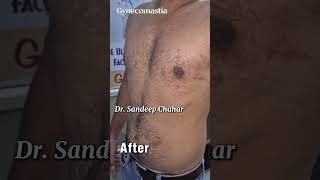 #gynecomastia/male breast #surgery result #hisar #haryana #bestplasticsurgeon dr Sandeep chahar