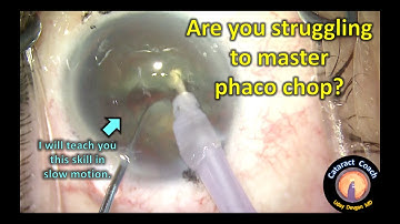 Struggling with Phaco Chop? Let me help you