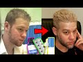Finasteride, RU58841 And Minoxidil 10 Years Later Before & After Results