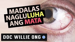 Madalas Nag-LULUHA ang MATA - ni Doc Yul Dorotheo (Eye Doctor) #2b