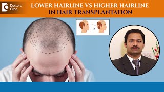 Best Hairline ever recreated | Hair Transplant lower or higher ?-Dr.Deepak P Devakar|Doctors