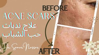 Acne scars العلاج النهائي لندبات  حب_الشباب