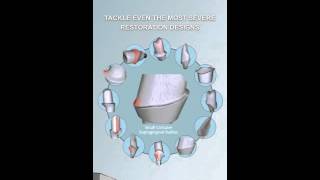 The Axsys Advantage Custom Abutment Libraries Machining Templates