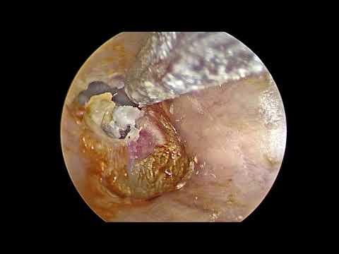 Video: Otitis Media - Gejala, Rawatan Telinga, Diagnosis Pada Kanak-kanak