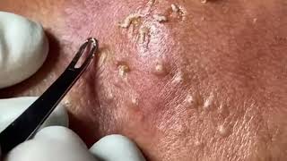 (Sebum Removal) A Day When I Feel Sad To Goodbye To My Nose And Sebum