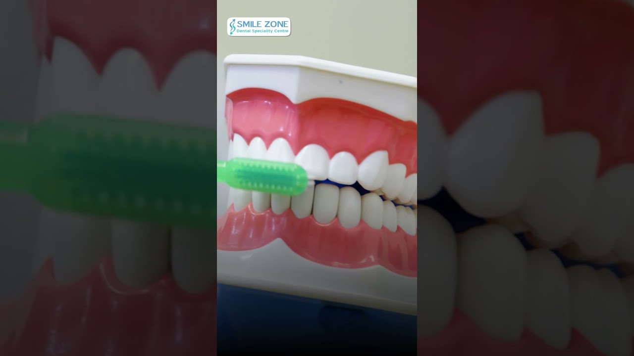 Restore, Rebuild, Rediscover Your Smile: Dentist in Bangalore | Smile Zone Dental Speciality Centre