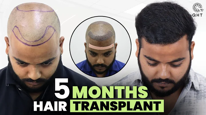 Hair Transplant in Mumbai (HX-ACRB) | Best Results & Cost of Hair Transplant in Mumbai