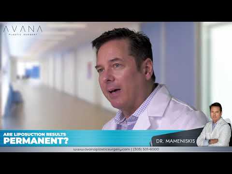 Are Liposuction results permanent? - Dr. Mameniskis explains