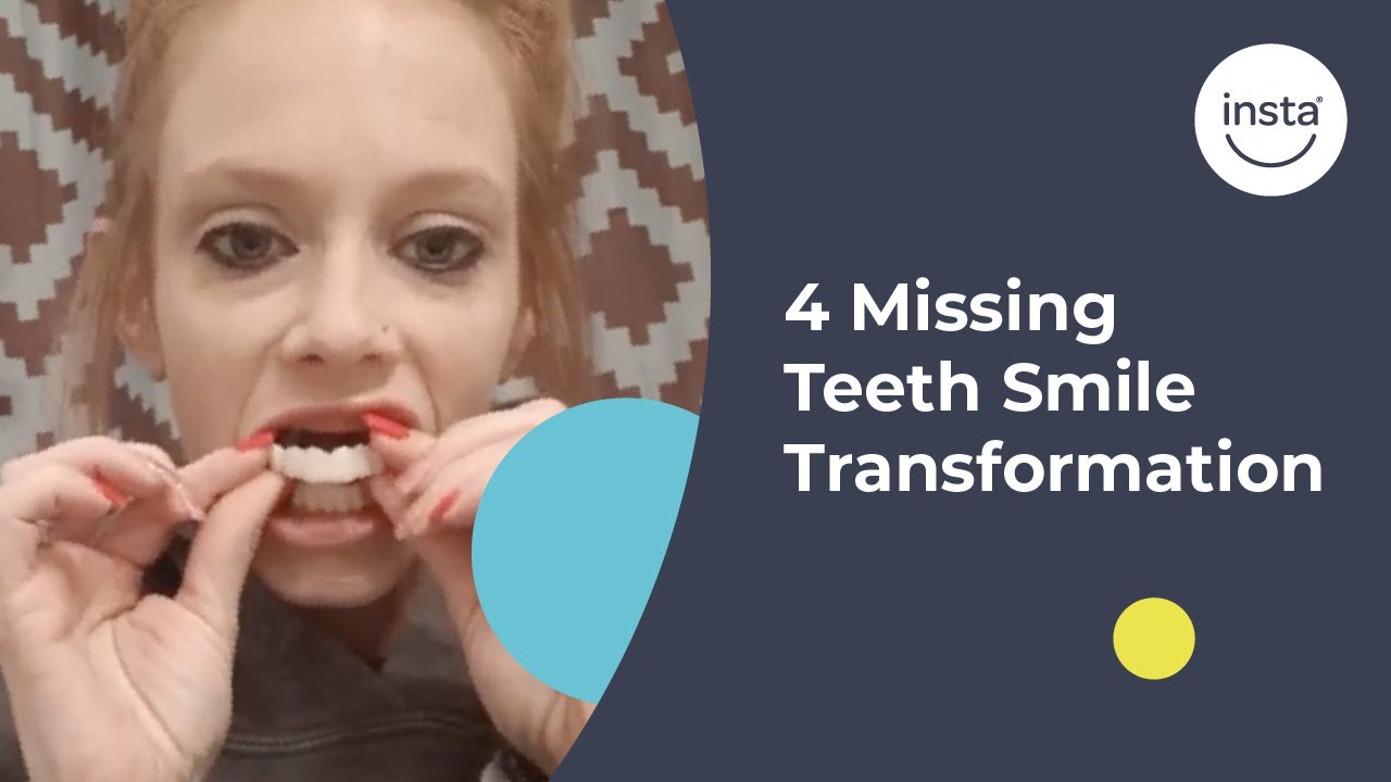 covering-4-missing-teeth-clip-on-veneers-instasmile-review-youtube