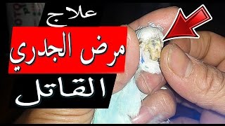 علاج مرض الجدري القاتل لطيور البادجي   Treatment of smallpox for budgies