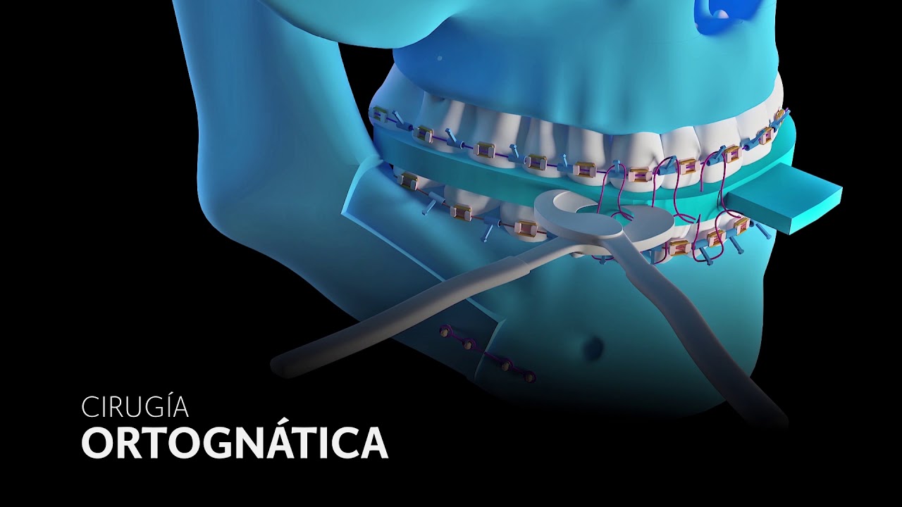 ✅ CONOCE LAS 2 FASES DE LA CIRUGÍA ORTOGNÁTICA ► Cirugía Maxilofacial