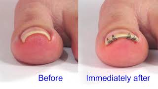 English v4: Ingrown toenail correction device &quot;NailLift&quot; procedure