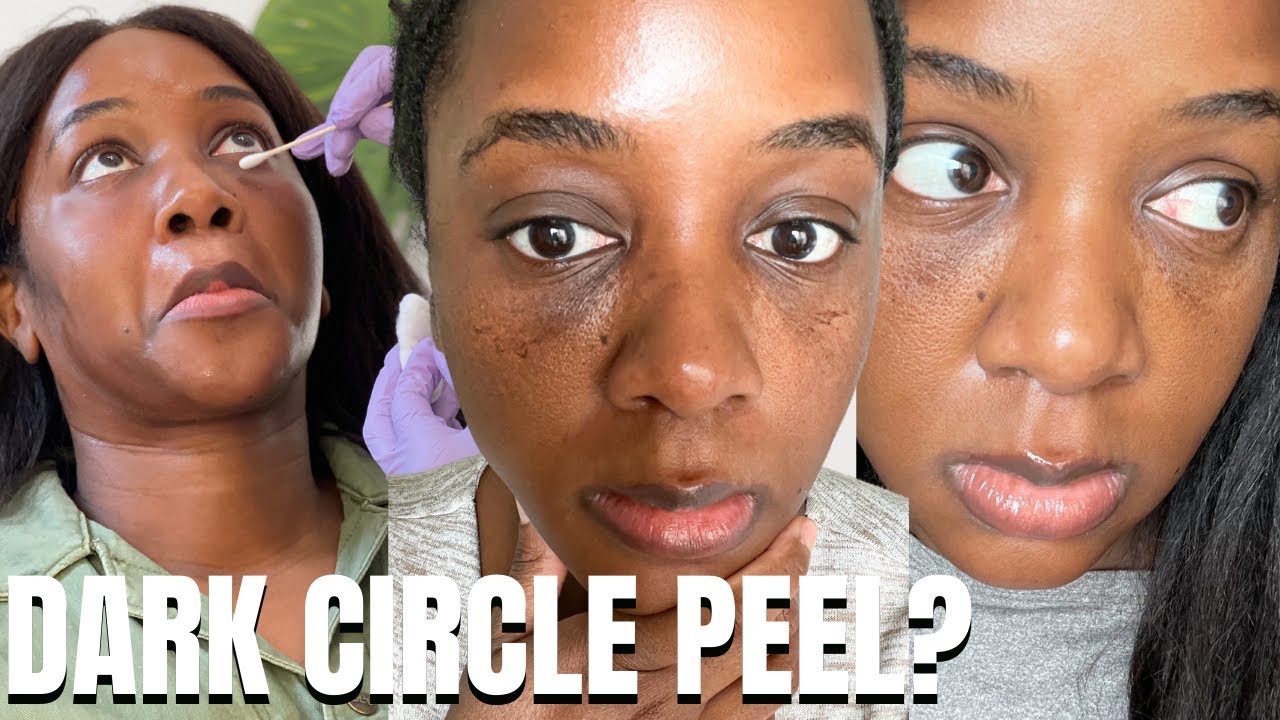 Tca Chemical Peel On Black Skin (Before And After: Dark Circles) - Youtube