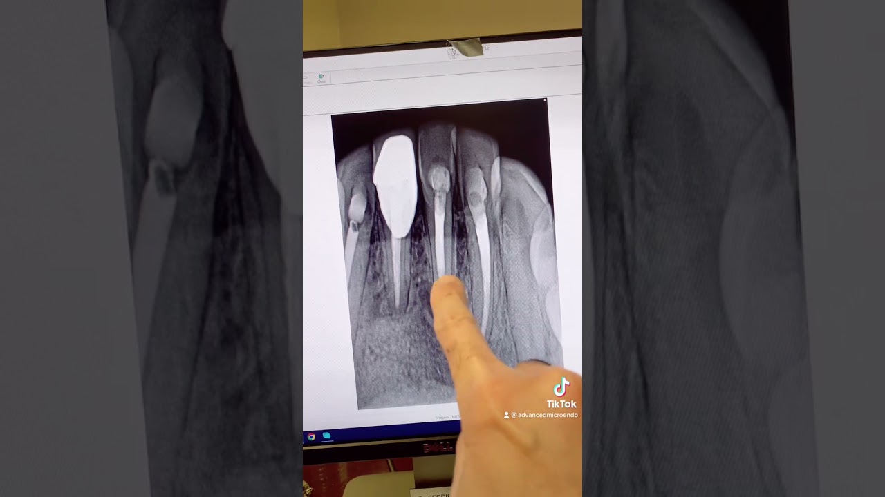 Endodontic retx of tooth #24 in one visit.