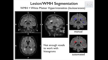 9. Segmentation: White Matter Hyper-intensities and BIANCA (Struc E3)