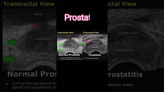normal prostate vs hyperplasia #medical #medicalimaging #kidney #baby #shorts