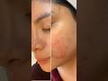 #skin💃transformation #skincare #satisfying #beautycare #skin #viralvideo #shorts