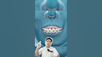 Hàm Hô Sẽ phải phẫu thuật cắt xương hàm - niềng răng #rang #nhakhoa