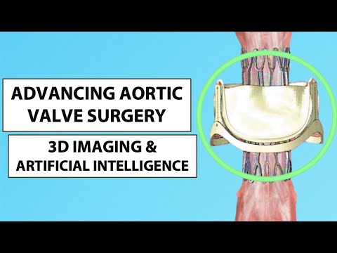 Patient Webinar: Advances in Aortic Valve Surgery with 3D Imaging & Artificial Intelligence