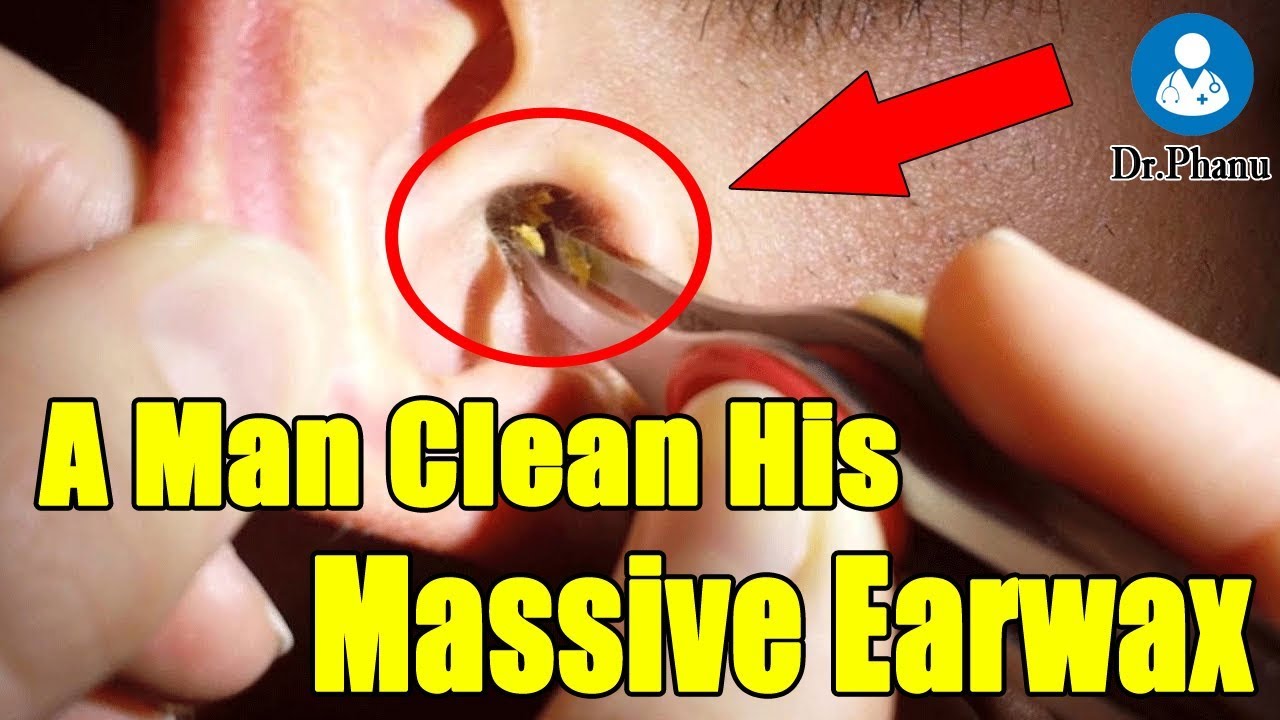 Ear wax removal in Vietnam a young man clean his Earwax YouTube