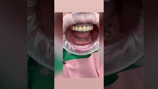 🛑Удалили все зубы?😴1 000000 просмотров ❓ #шортс #медицина #зубы #имплантациязубов