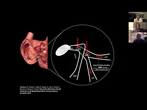 Left Bundle Branch Pacing Webinar