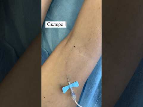 #лечениеварикоза #флебологмосква #флеболог #шортс #варикоз_как_избавиться #полезности #допосле
