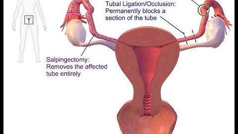 Laparoscopy salpingectomy CPT code - simplify medical coding