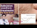 Subcision Treatment For Acne Scars | Subcision Treatment In Jaipur |Dr Sunil Kothiwala Dermatologist
