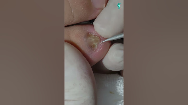 😳 THIS TOEnail HAS BEEN INGROWN FOR YEARS – LOOK WHAT WAS INSIDE! #podologomaurelio #shorts