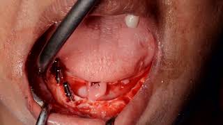 Periodontally weekened lower teeth extraction with replacement of basal  dental implants