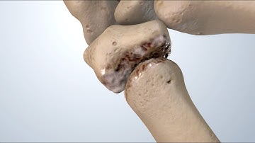 Osteoarthritis of the Thumb