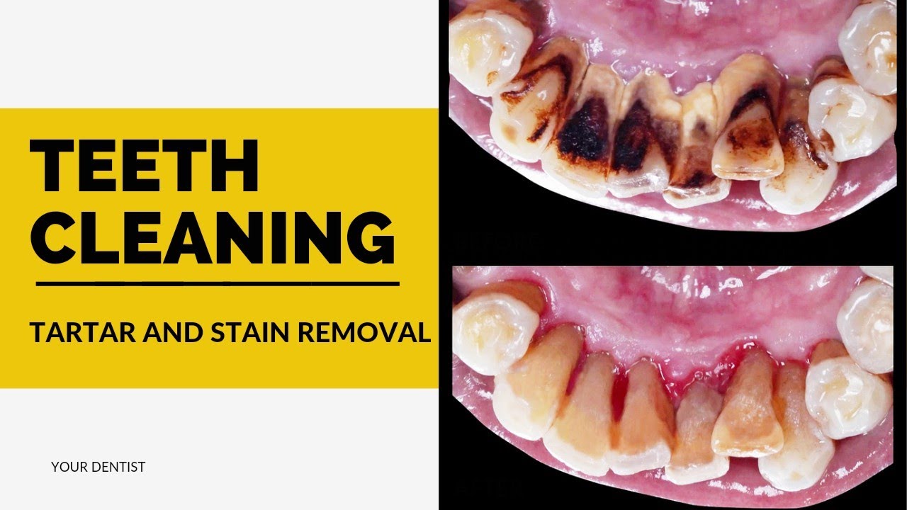 Stain and Tartar Removal from teeth by doctor Professional teeth