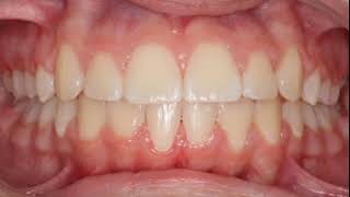Gessel Orthodontics - Smile Transformation with Braces or Invisalign - Tacoma, WA Orthodontist