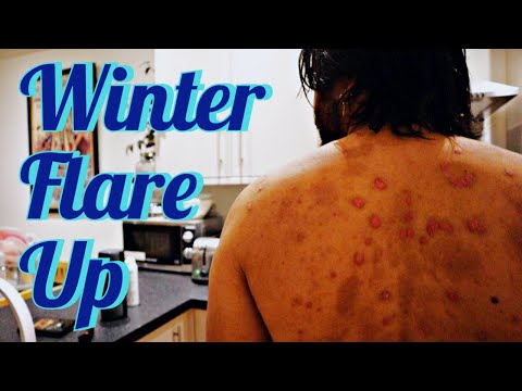 Video: Psoriasis Pada Musim Panas: Meminimumkan Flare-Ups