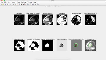 Matlab: Segmentación del borde epicárdico (Verde) y endocárdico (rojo)